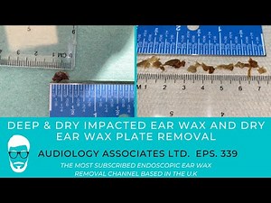 DEEP DRY IMPACTED EAR WAX REMOVAL AND DRY EAR WAX PLATE REMOVAL - EP 389
