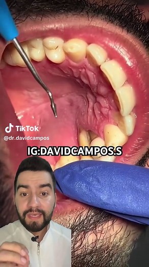 Diente movible y periodontitis: Causas y tratamiento