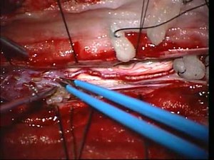 Arteriovenous Malformation Of The Spinal Cord • Video • MEDtube.net
