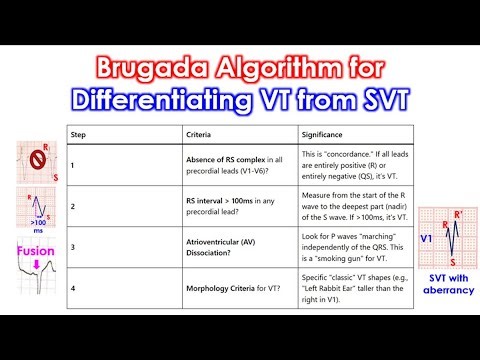 Brugada Algorithm for Differentiating VT from SVT