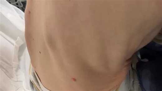 During inspiration, the lower intercostal spaces retract. This is: A. Kussmaul sign B. Hoover’s sign C. Hamman’s sign D. Trousseau sign | Cardiophilia