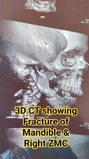 XRAY : CT SCAN OF MAXILLOFACIAL REGION #xray #ct #viral #health #surgery #surgeon #hospital #doctor