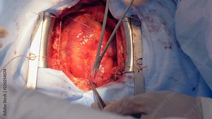 One surgeon uses scissors and a medical needle to sew patient's heart. 4K.