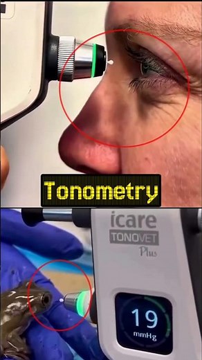 eye pressure / glaucoma #tonometry #eyepressure #opticnerve #glaucoma