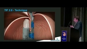 Endoscopic Treatment of Gastroesophageal Reflux: Are We There Yet?