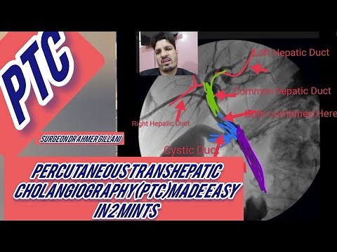 PTC(percutaneous Transhepatic Cholangiography) Made Easy
