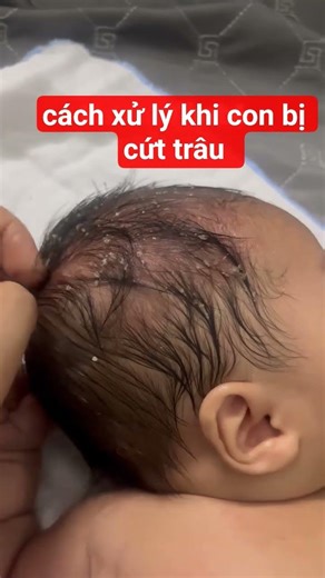 xử lý " cứt trâu" ( viêm da tiết bã) ở trẻ sơ sinh #trending #chamsocbe #landaulamme #fyp #baby