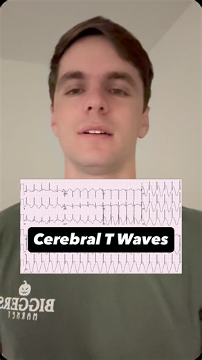 6.3K views · 50 reactions | Cerebral T Wave on ECG | ECG Lectures with Reid | Facebook