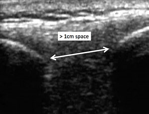 Ultrasound Guided Lumbar Puncture