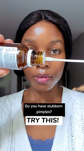 This helped a lot with my pimples. At-home pimple remedy #pimples #skincare #diy #viralshorts #viralreelsシ #reelsfypシ #fb #fbreelsfypシ゚viralシ #organicskincare #howtogetridofpimples | Aroma Talks