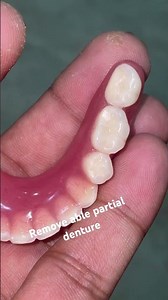 Remove able partial denture 😬😬😬#apexdental #splittooth #dentistry #partialdenture #orthodontist