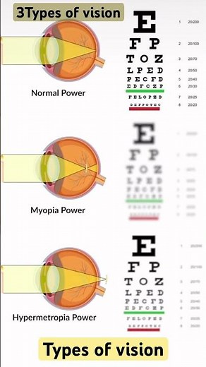 👁️ Myopia vs Hypermetropia vs Normal Vision | 3 Types of Vision