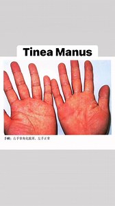 3K views · 12 reactions | Tinea Manus – Study Notes 1. Etiology •...