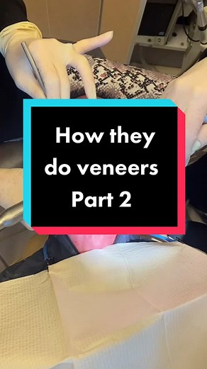 Cosmetic Veneers: A Comprehensive Guide