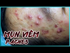 Big Cystic Acne Blackheads Extraction Blackheads & Milia, Whiteheads Removal Pimple Popping