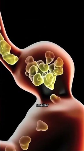 Gastric Band Surgery (3D Animation) #abdominalsurgery #gastricballoon #sleevegastrectomy