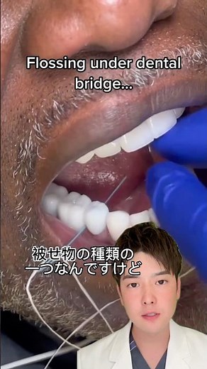 ブリッジについて説明します😊🦷☝️#歯医者 #おすすめ #虫歯