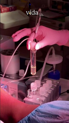 This is how eggs are retrieved in fertility clinics: Ovarian puncture | Vida Fertility