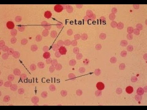 Kleihauer Betke Test; blood test to detect fetal red blood cells in maternal bloodstream