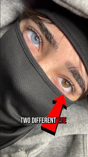 🔥 Rare Eye Condition: Why Some Eyes Have Different Colors #shorts