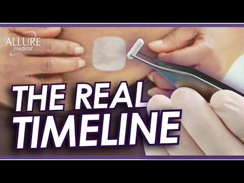 How Long Hormone Pellets Take to Work: What You Can Expect