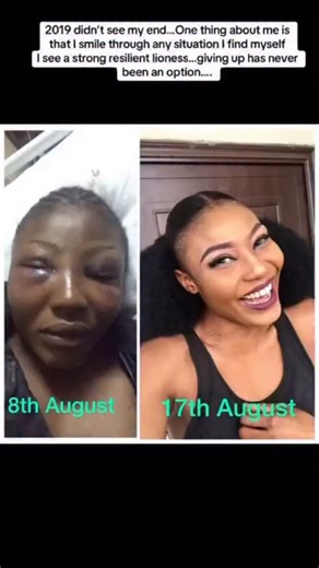 Lindaikejiblog on Instagram: "Nigerian lady recalls her harrowing encounter with ‘one-chance’ criminals in Abuja A Nigerian lady, Gina Obiora, has recalled her ordeal in the hands of one-chance criminals in Abuja. According to her, the incident happened in 2019. She shared a video showing her swollen and battered face, expressing gratitude to God for surviving an attack that has claimed the lives of several women in the nation’s capital. “In 2019 I was the only one in Abuja.No family to care for