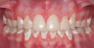 Why do I have white spots on my teeth? - Peninsula Orthodontics
