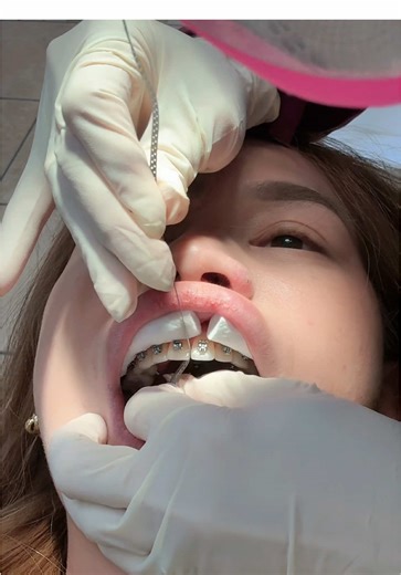 Reshaping Teeth with Sandpaper Strip Techniques