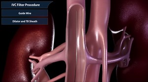 Inferior vena cava filter procedure.