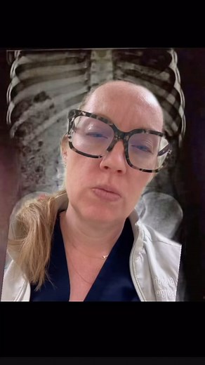 Diastematomyelia, a type of spina bifida, describes a congenital spinal dysraphism resulting in a split cord malformation. The spinal cord is longitudinally divided into two ‘hemicords,’ each surrounded by its own dural tube and separated by a midline bony spur or cartilaginous or fibrous ridge or band. Two actual intact spines is rare, and only documented in a few case reports! #splitspine #twospine #spine #neurosurgery #raredisease #spineduplication #doctor #neurosurgeon #spinabifida #splitcor