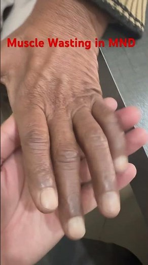Muscle wasting in MND #motorneuronedisease #ALS #awareness