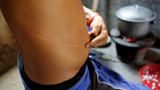 Need a kidney? Inside the world’s biggest organ market