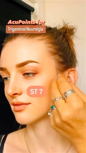 13K views · 274 reactions | Trigeminal Neuralgia is a chronic pain...