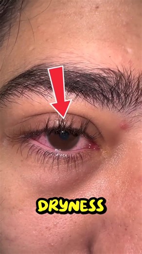 👀 Why Do Eyes Burn Again and Again? 😮📱