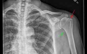 Hill Sachs Deformity