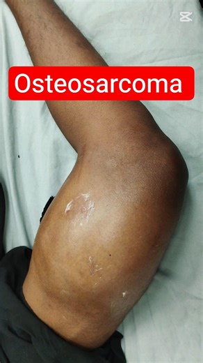 How does osteosarcoma present clinically and on X-rays? #young #health #adult #pathology #bone #zb