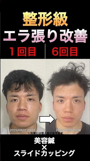 シワより【エラ張り】の方が簡単！！#えら張り #小顔 #男性美容