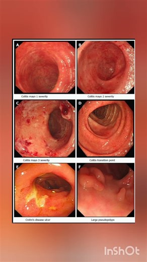 “Understanding Colon Diseaes Explained Simply!”