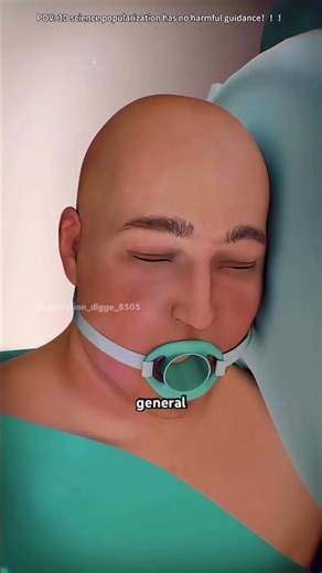 How Incisionless Fundoplication Surgery Is Performed (3D Animation)#endoscopicsurgery#gerd