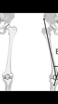 Precise measurement of knee Q-angle #angle #kneepainrelief #kneepain #quadriceps #knee #alignment