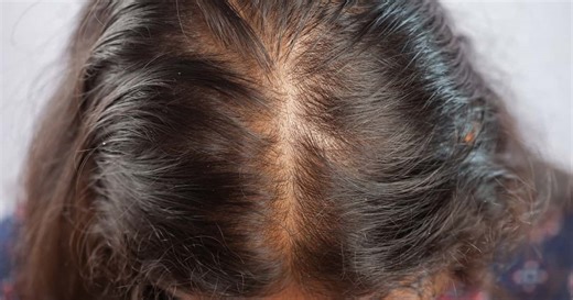 Alopecia androgenética: causas, sintomas e tratamento