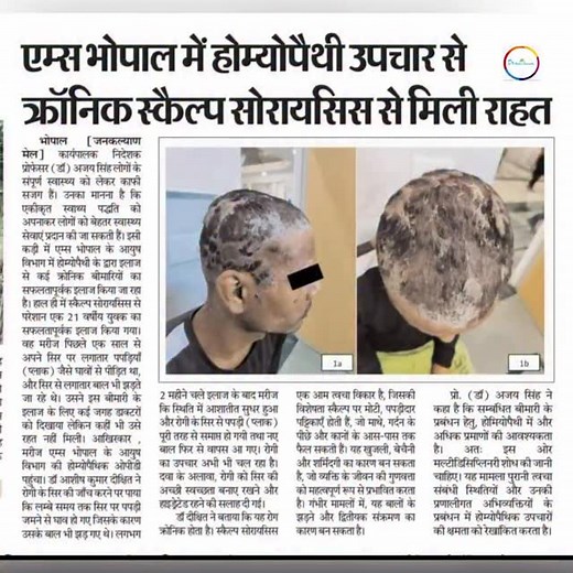 9.9K views · 142 reactions | Scalp Psoriasis can be deeply...