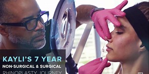 Kayli's 7 year non-surgical & surgical rhinoplasty journey