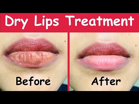 Best Natural Dry Lips Treatment, Dry Lips Treatment at home with Magical Results