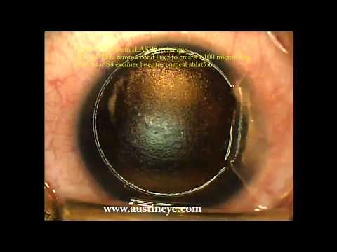 LASIK surgery explained step-by-step by Shannon Wong, MD. 12-21-11.