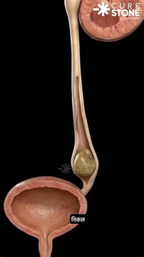 Inside the Ureter: How a Kidney Stone Moves (Kidney to Bladder) ⚠️