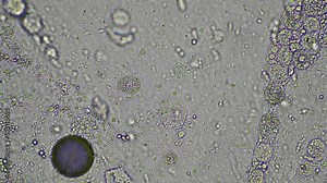 person with a virus coughing, Phlegm and mucus under the microscope