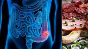 Tres alimentos relacionados con el cáncer de colon que debe reducir en su consumo: es mejor subirle a las verduras