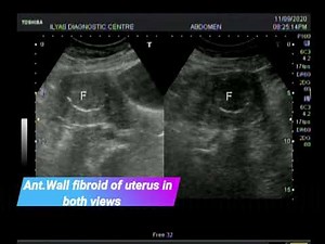anterior uterine wall fibroid