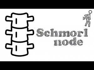 Schmorl nodes on MRI - a brief look
